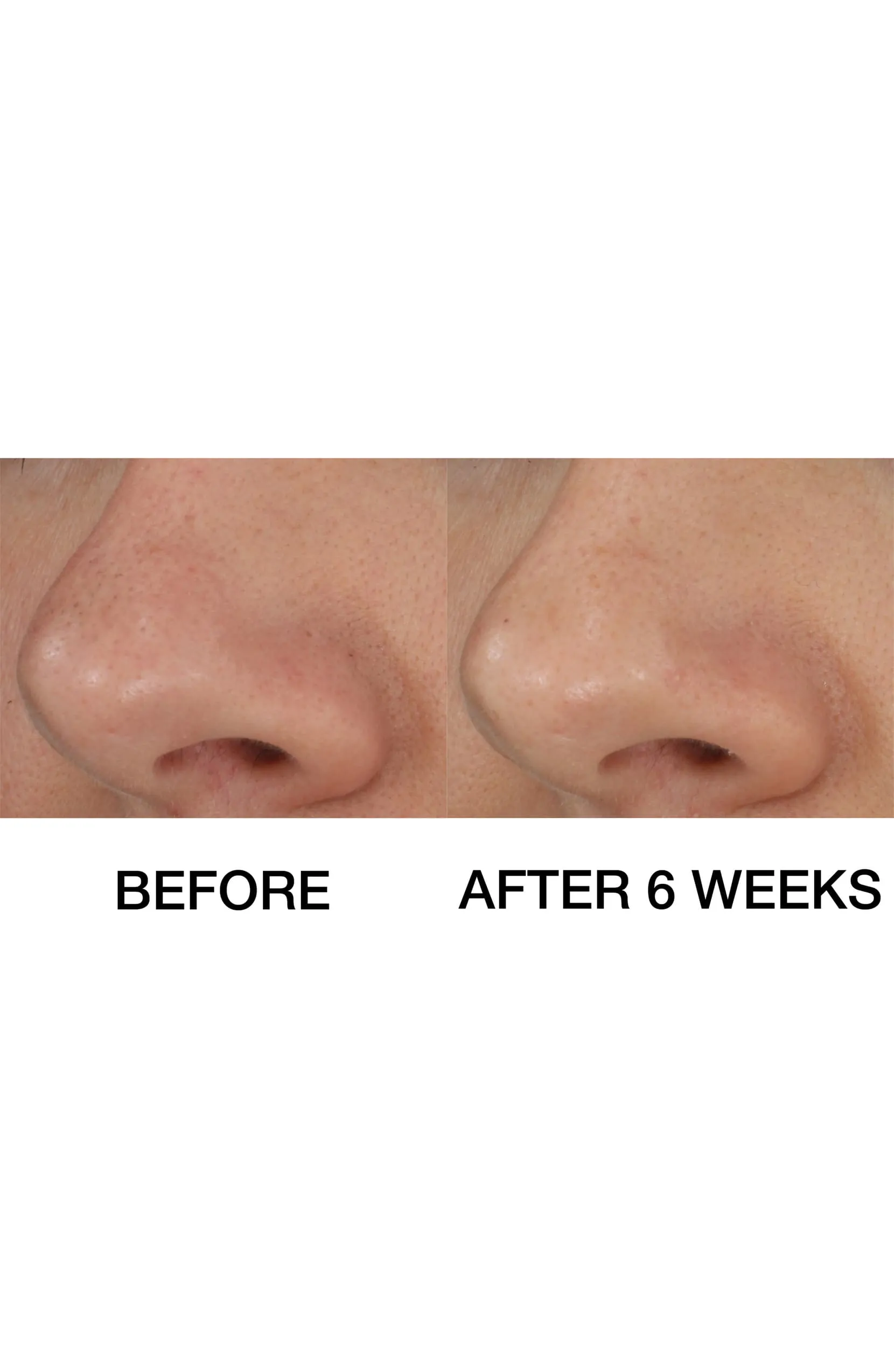 Clinique Blackhead Solutions Self-Heating Blackhead Extractor